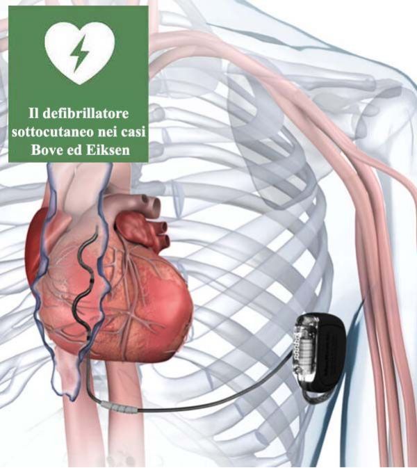 Il defibrillatore sottocutaneo: un nuovo alleato per il cuore degli atleti